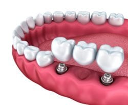 dental implant dental bridge florence sc implant dentist