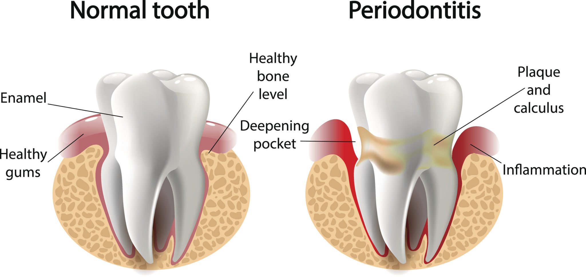 gum disease periodontal therapy for bleeding gums Florence SC