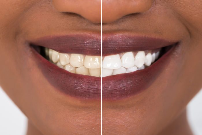 Teeth whitening for discolored teeth whiter teeth florence sc cosmetic teeth whitening