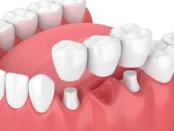 dental bridge removable dental bridge for missing teeth florence sc