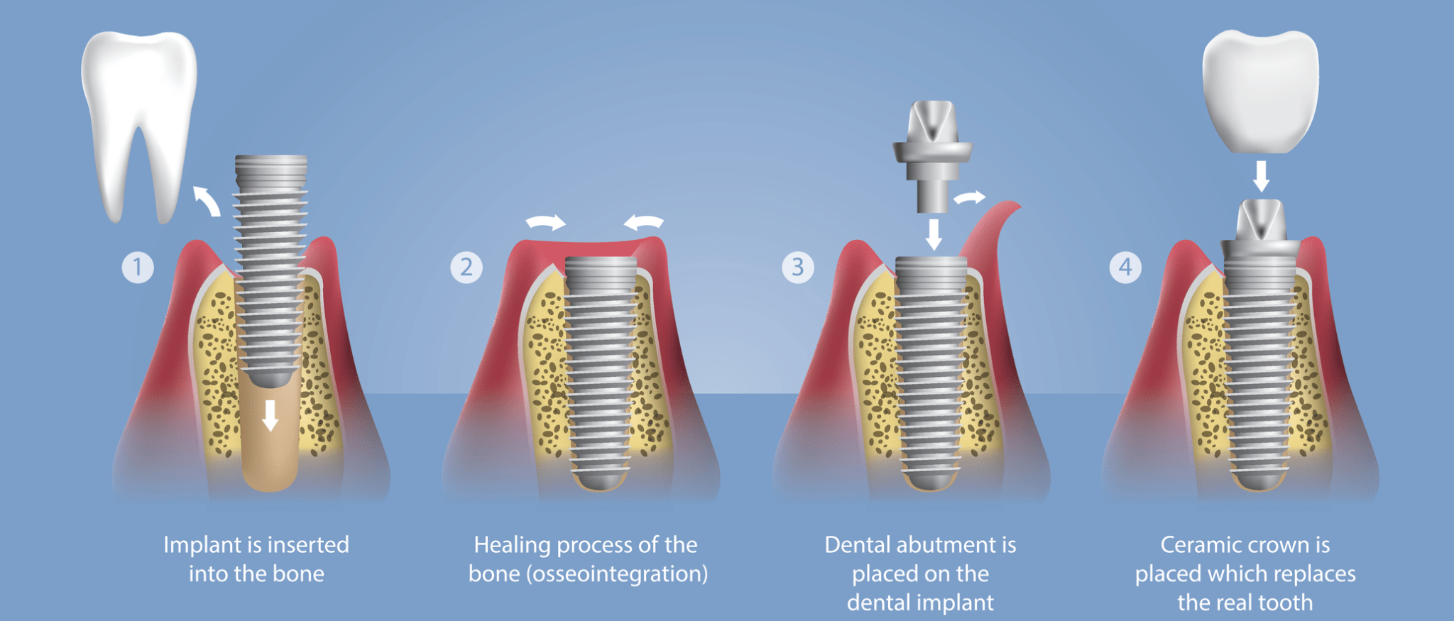 dental implant procedure for missing teeth implant dentist Florence SC