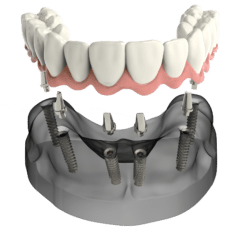 implant secured denture for missing teeth implant dentist Florence SC