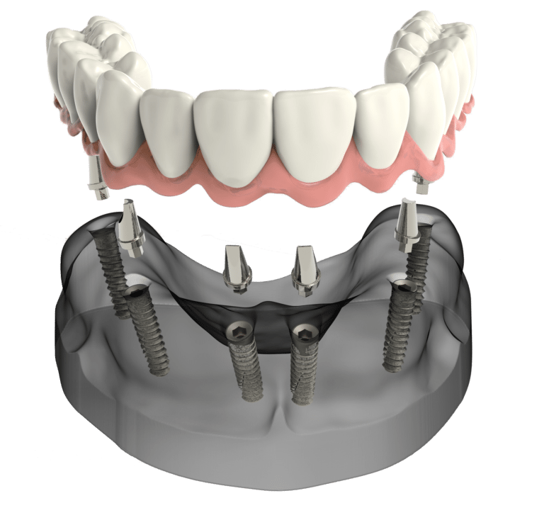 Dentures Florence SC Partial & Implant Dentures Darlington