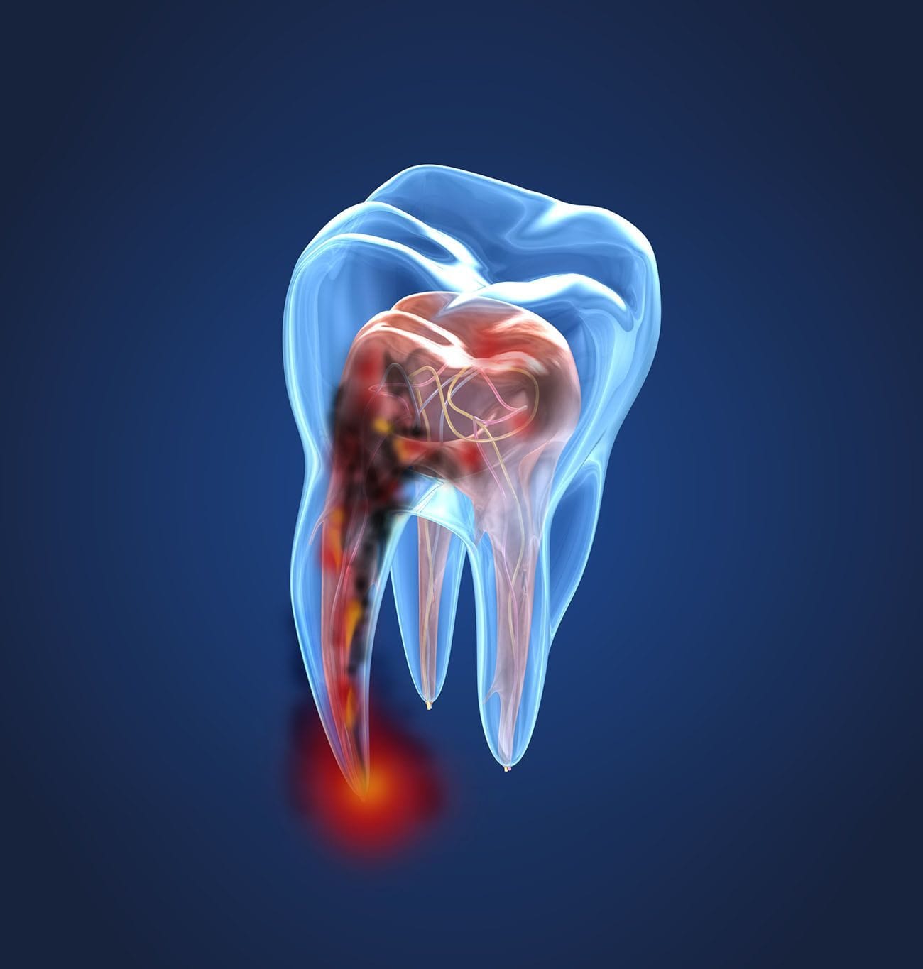 What Can I Expect From A Root Canal Dentist In Florence SC