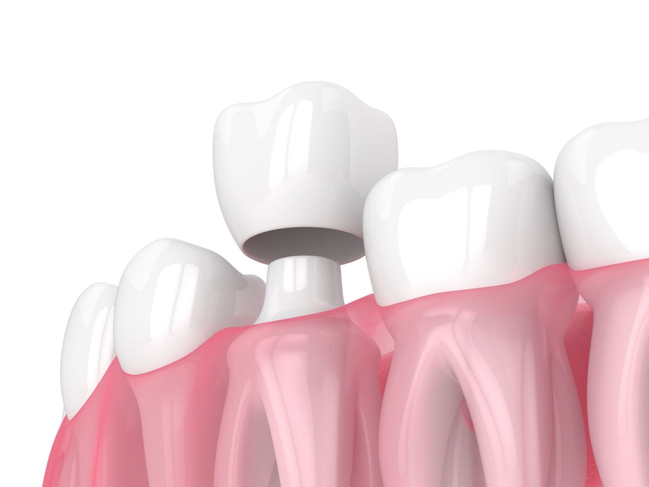 dental crowns in florence sc