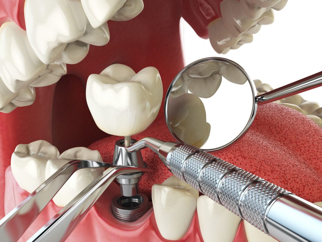 dental implants dentist florence sc