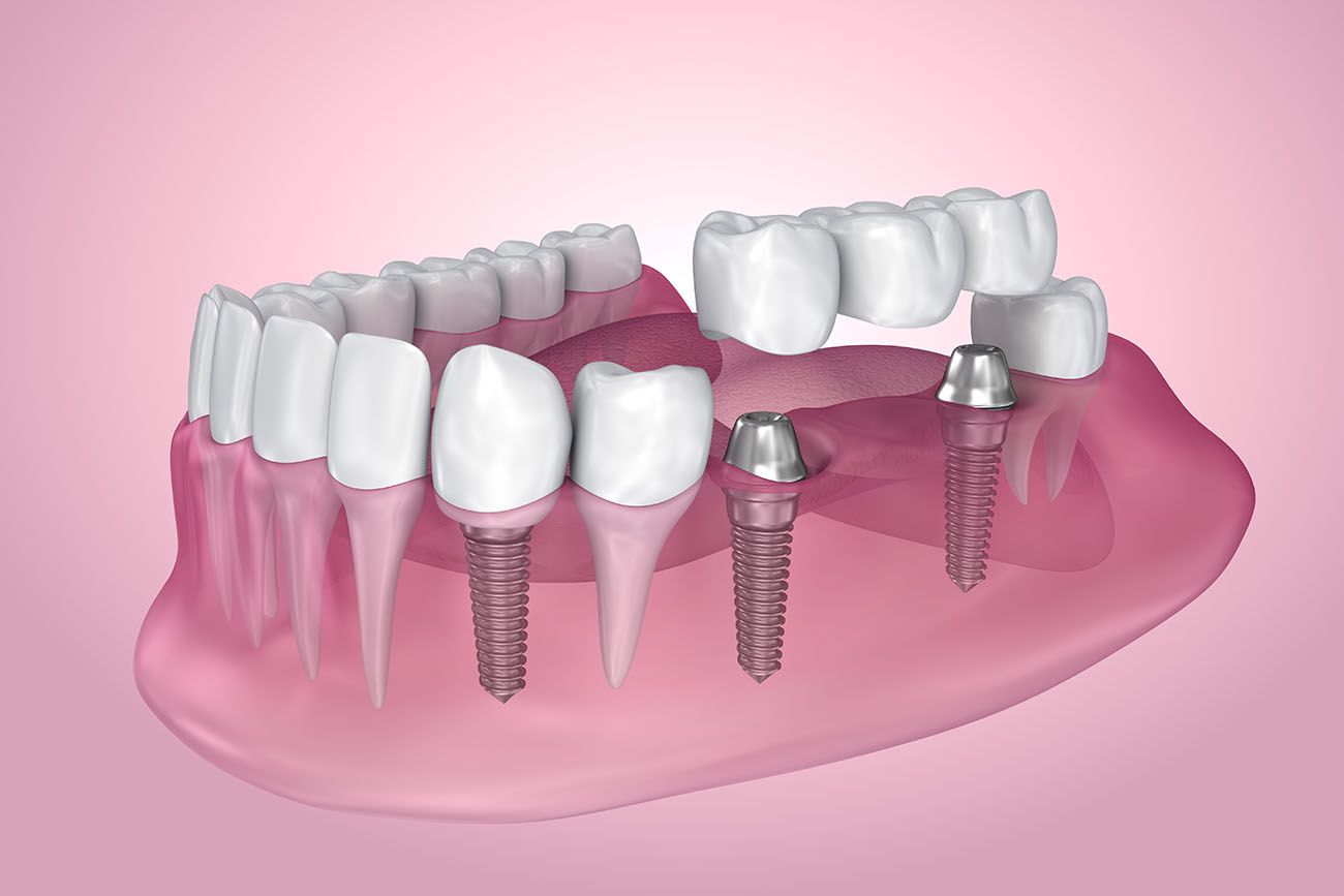 multiple dental implant procedure