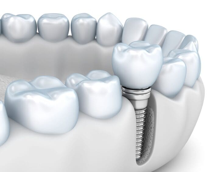 How Implants Support Oral Health