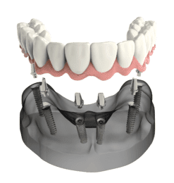 Hybrid Denture Florence, SC