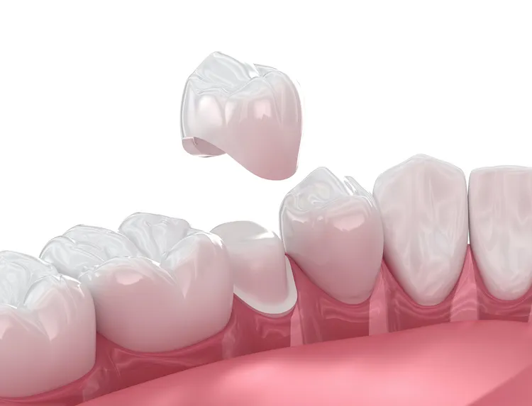 What Is a Dental Crown? in Florence, SC